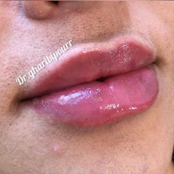 تزریق-ژل-لب-در-کرج-دکتر-غریبی-پور