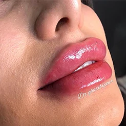 عکس-تزریق-ژل-لب-دکتر-غریبی-پور