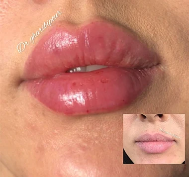 نمونه-تزریق-ژل-لب-در-کرج
