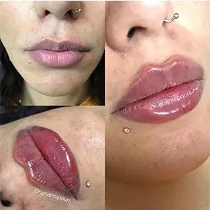 نمونه-تزریق-ژل-لب-روسی-در-کرج