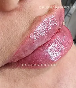 نمونه-کار-تزریق-ژل-لب-در-کرج