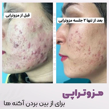 مزوتراپی