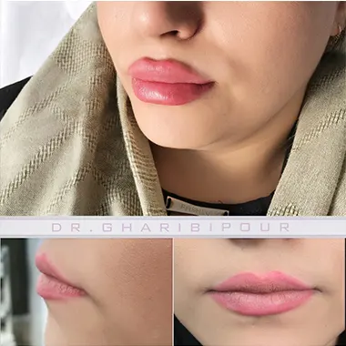 هزینه تزریق ژل در کرج سال 1402