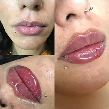 هزینه تزریق ژل در کرج
