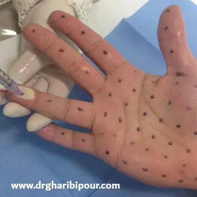 بوتاکس کف دست