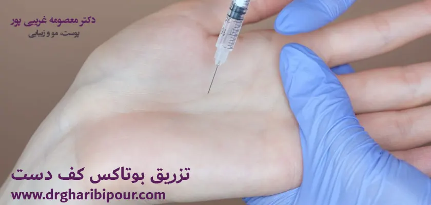 تزریق بوتاکس کف دست
