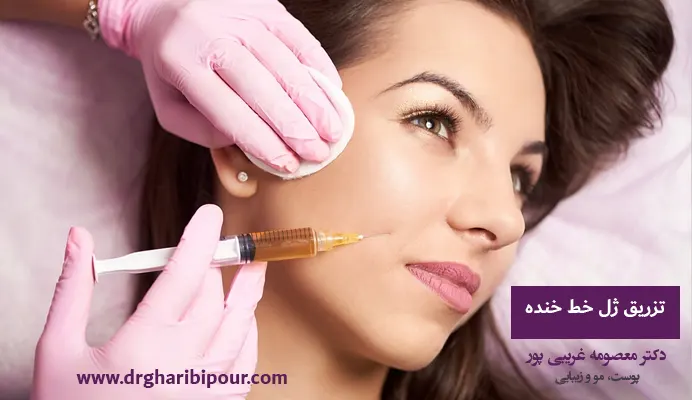تزریق ژل خط خنده
