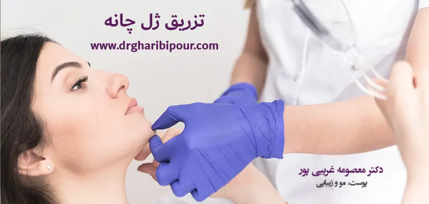 تزریق ژل چانه در کرج