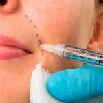 مزایای تزریق ژل خط خنده