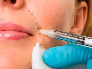 مزایای تزریق ژل خط خنده