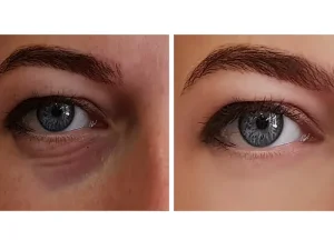 مزوتراپی دور چشم
