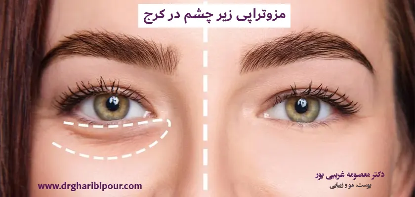 مزوتراپی زیر چشم در کرج