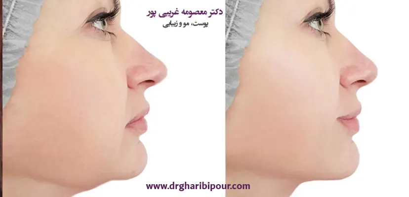 مزوتراپی غبغب