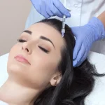 مزوتراپی موی سر