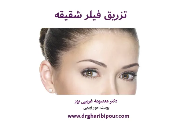 تزریق فیلر شقیقه