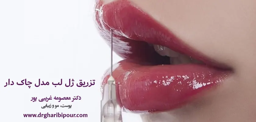 تزریق ژل لب مدل چاک دار
