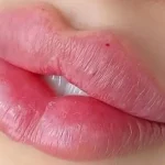 هزینه تزریق ژل لب مدل چاک دار
