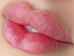 هزینه تزریق ژل لب مدل چاک دار