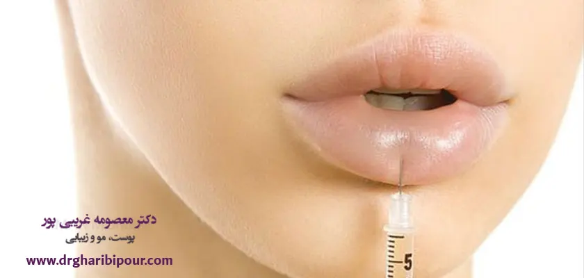 ژل لب مدل چاک دار