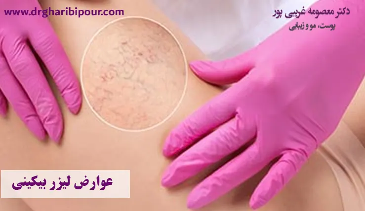 عوارض لیزر بیکینی
