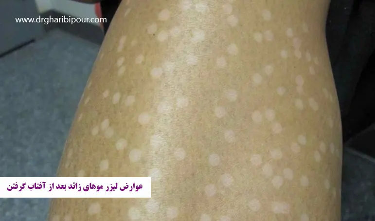 عوارض لیزر موهای زائد بعد از آفتاب گرفتن
