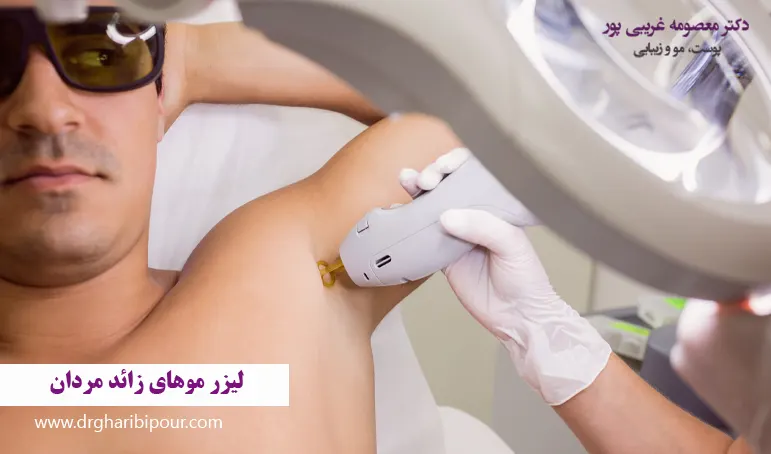 لیزر موهای زائد مردان