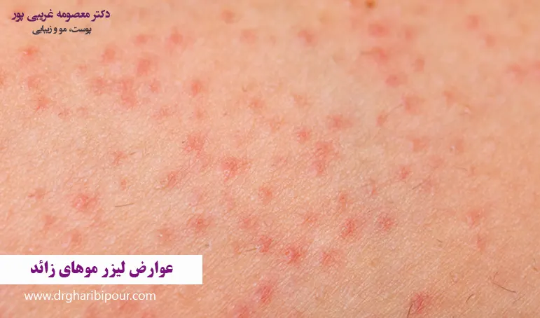 عوارض لیزر موهای زائد