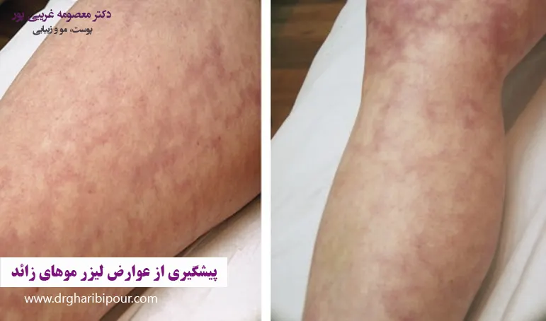 پیشگیری از عوارض لیزر موهای زائد